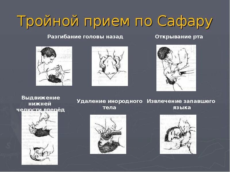 Прием теле. Выдвижение нижней челюсти перед началом реанимации. Прием Сафара при сердечно легочной реанимации. Подготовка к сердечно-легочной реанимации тройной прием Сафара. Выдвижение нижней челюсти перед началом реанимации для чего.