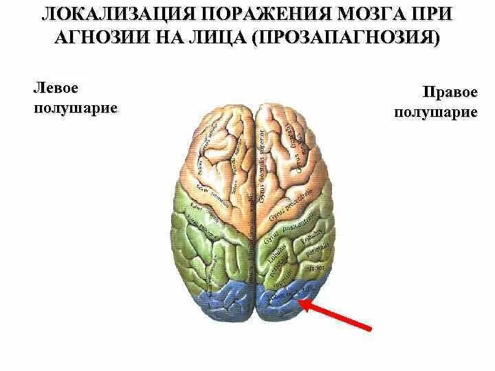 Аутотопагнозия локализация поражения. Локализация поражения при агнозии. Локализация поражений мозга. Агнозия мозг. Поражение правого полушария мозга