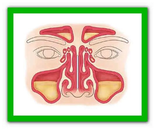 Слизистая при гайморите. Почему бывают сопли