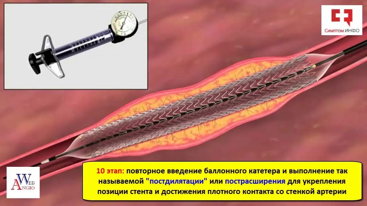 Стент видео. Баллонная ангиопластика нижних конечностей. Стентирование поверхностной бедренной артерии. Стентирование дилатация. Баллонная ангиопластика и стентирование.