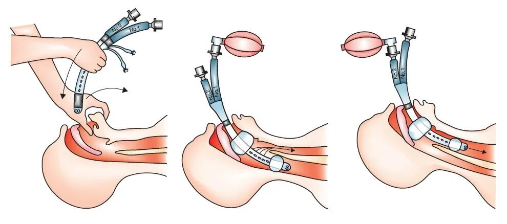 Вводи плавнее. Интубация трахеи эндотрахеальной трубкой. Интубация трахеи методика выполнения.