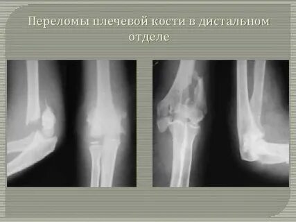 Переломы плечевой кости у детей