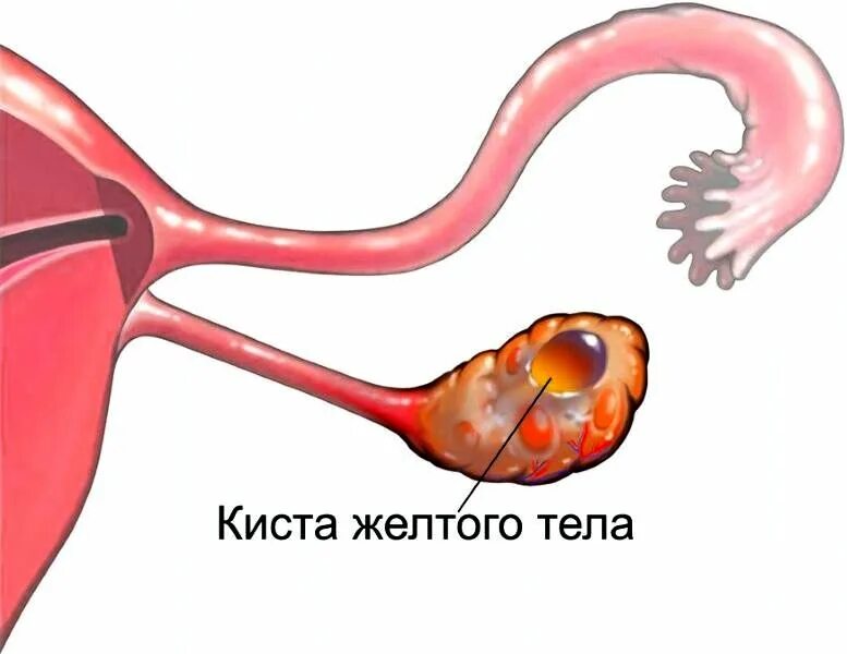 Разрыв овуляции. Киста желтого тела яичников. Функциональная киста яичника или желтое тело. Киста желтого тела левого яичника. Регресс кисты желтого тела.