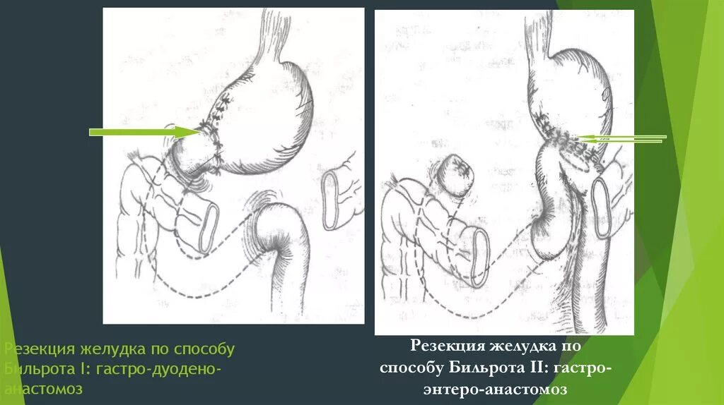 Резекция желудка с гастроеюноанастомозом. Операция по Бильрот 1 рентген. Резекция желудка по Бильрот 1 рентгеноскопия. Анастомозит что это