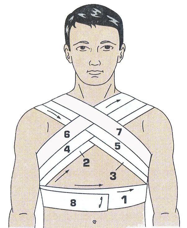 Перелом ключицы Косыночная повязка. Наложение восьмиобразной повязки при переломе ключицы. 8 Образная повязка при переломе ключицы. Кольца Дезо Дельбе.
