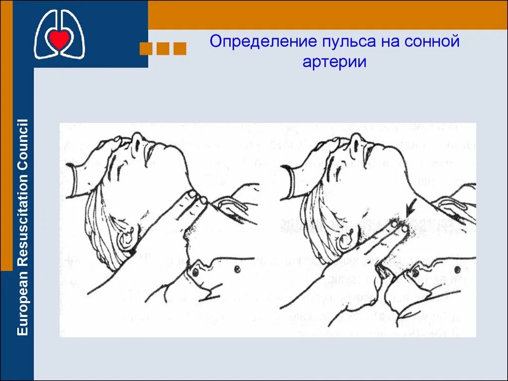 Определение пульса на сонной артерии. Оценка пульса на сонной артерии. Пульсар на сонной артерии. Определение пульсации на сонной артерии. Сонная артерия как нащупать где