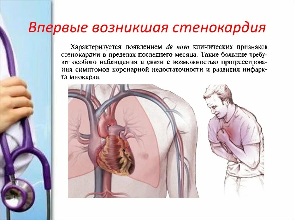 Что такое стенокардия и как. Стенокардия впервые возникшая симптомы. впервые возникшая стенокардия напряжения. клиническая характеристика впервые возникшей стенокардии.