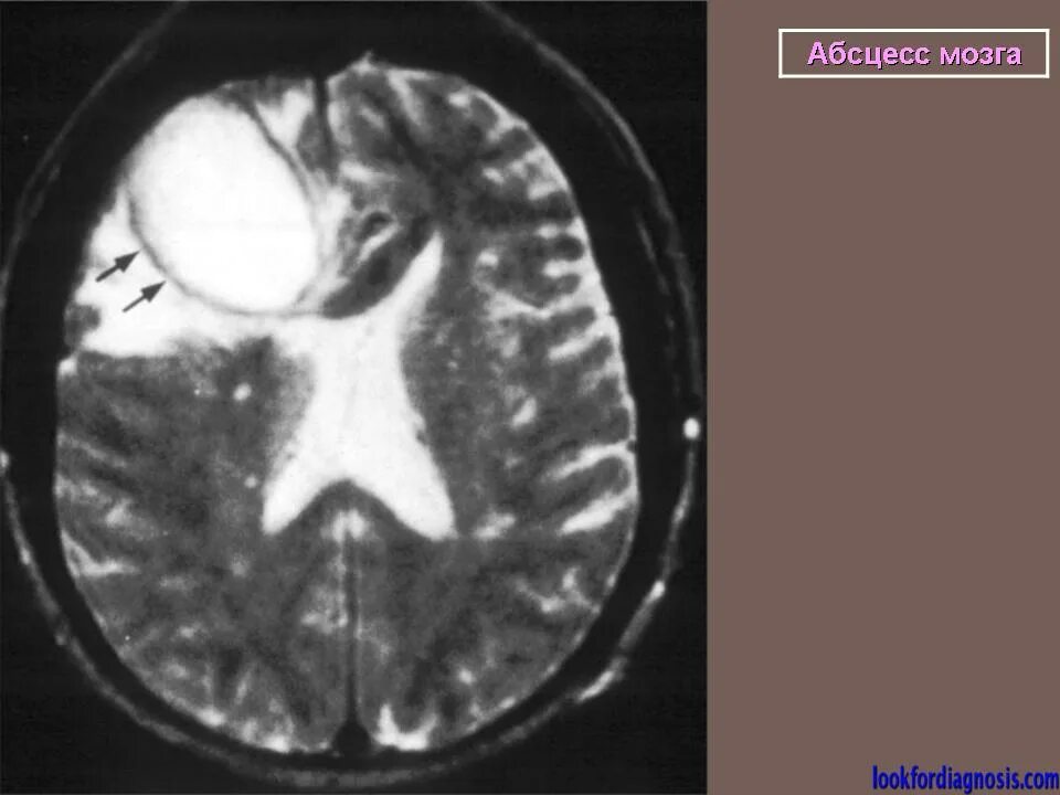 Абсцесс мозга. Перивентрикулярная киста головного. Абсцесс мозга диагностика. Абсцесс головного мозга УЗИ.