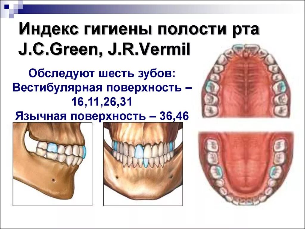 Гигиена рта состояние рта. Гигиенический индекс Грина-Вермильона. Упрощенный индекс гигиены полости рта Грина-Вермильона. Индекс гигиены Грина Вермиллиона. Индекс гигиены Грина Вермиллиона для зубного налета.