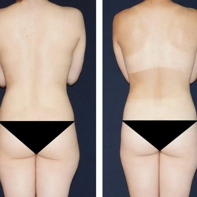 аслан липопластика. ручную пластику тела. ручную пластику тела. ушки на спине до и после. визитка ручная пластика тела.