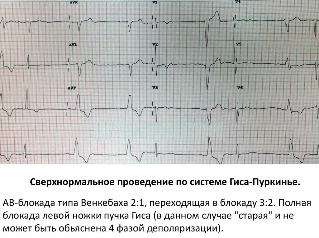 Аберрантная наджелудочковая экстрасистолия на ЭКГ. АВ Узловая экстрасистолия на ЭКГ. Блокада ножки пучка Гиса и желудочковые экстрасистолы. Наджелудочковая экстрасистолия с аберрантным проведением на ЭКГ. Аберрантные экстрасистолы