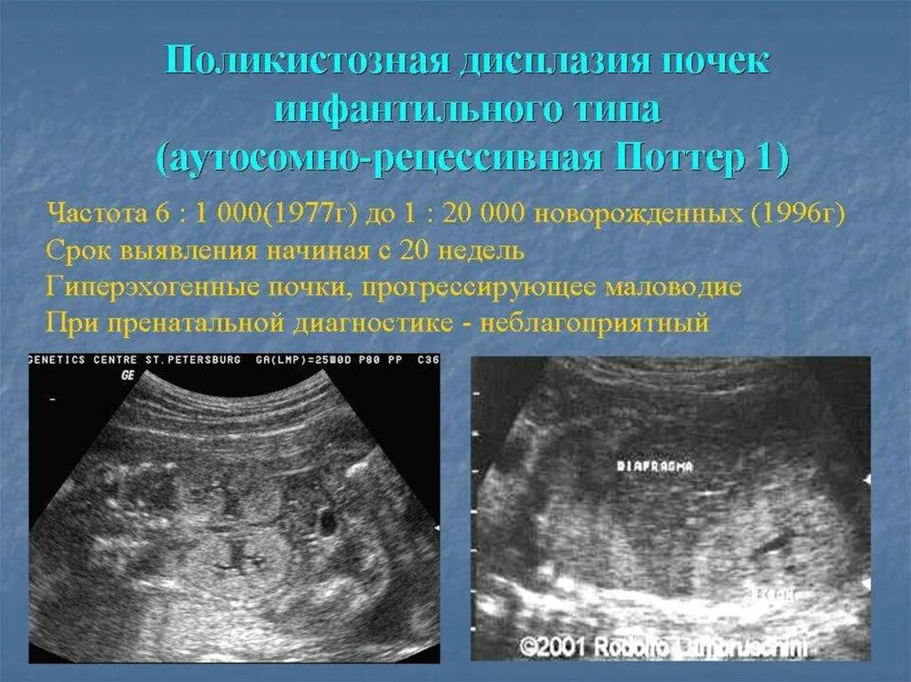Дисплазия паренхимы почек. Дисплазия почек это. Мультикистозная дисплазия почки у ребенка. Дисплазия почек это. Сегментарная дисплазия почки.