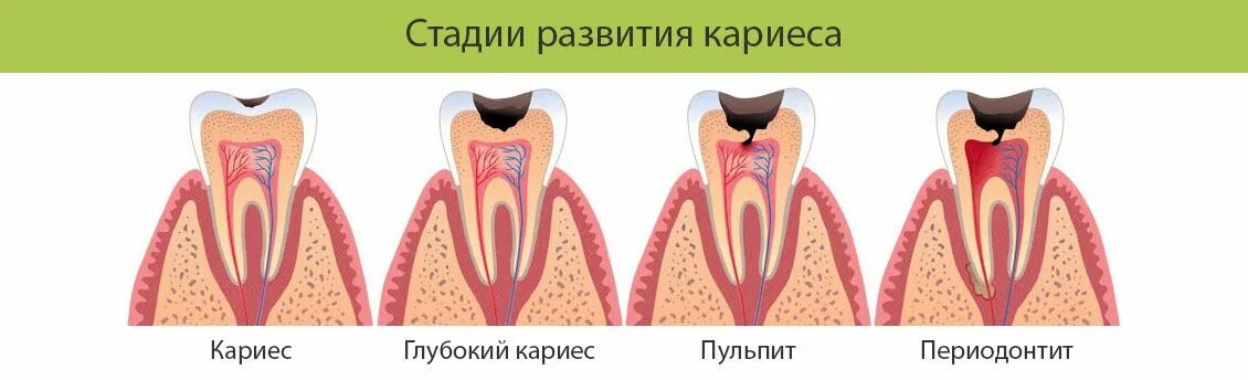 Кариес пульпит периодонтит. Пульпит и периодонтит отличия. 4 Канальный пульпит зуба. Зубы кариес пульпит периодонтит. Осложнение лечения периодонтита