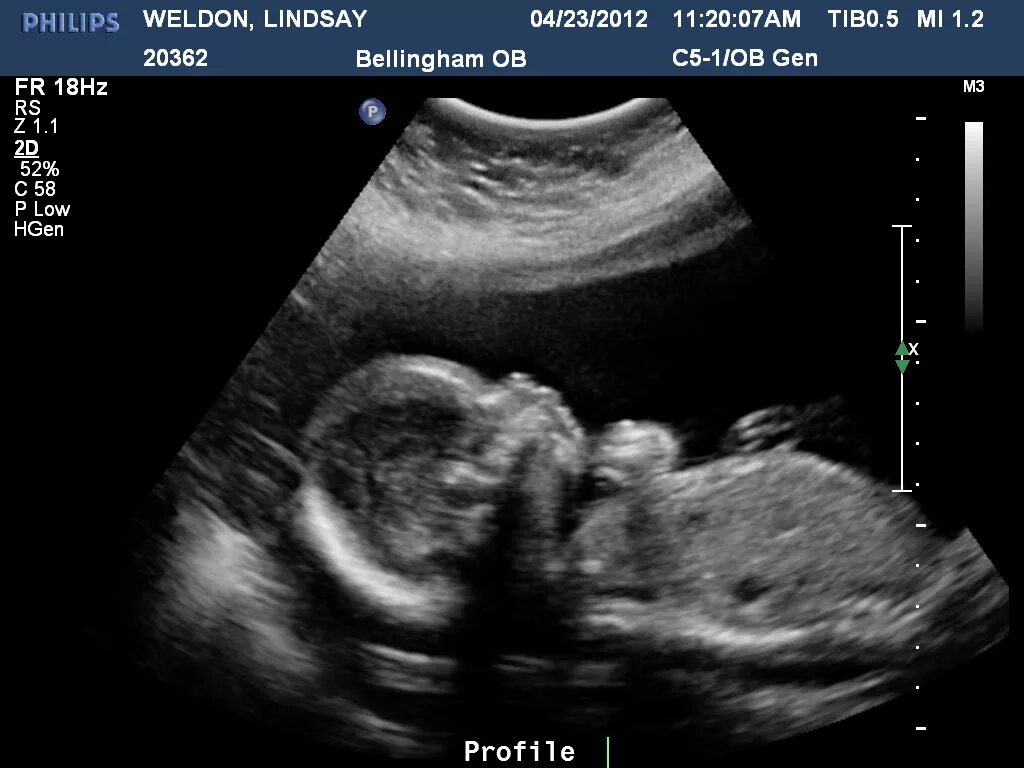22 недели беременности размер. В 20 недель беременности ФО то плодс. Ребёнок в 20 недель беременности фото. Зародыш 20 недель беременности. Размер плода на 19 неделе беременности УЗИ.