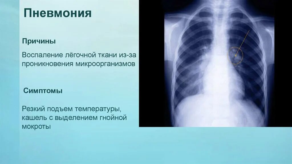 Причины пневмонии. Пневмония причины возникновения. Легкое течение пневмонии