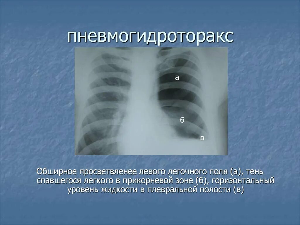Уровень на рентгене