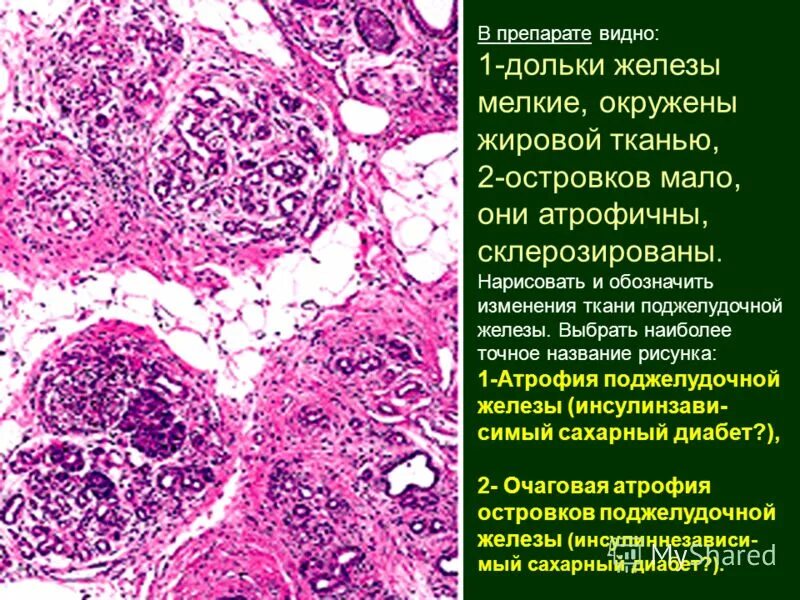 Поджелудочная железа фиброзные изменения. Липоматоз поджелудочной железы гистология. Поджелудочная железа макропрепарат. Поджелудочная железа при сахарном диабете 1 типа микропрепарат. Сахарный диабет 1 типа микропрепарат.