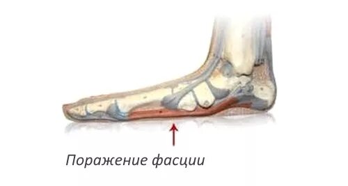 Болит стопа снизу. Болезнь Шульмана эозинофильный фасциит. Диффузный эозинофильный фасциит Шульмана.