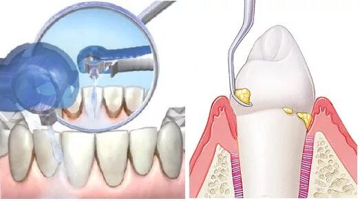Поддесневые отложения зубной камень. Скейлинг пародонтальных карманов. Поддесневой зубной налет. Как чистить десна