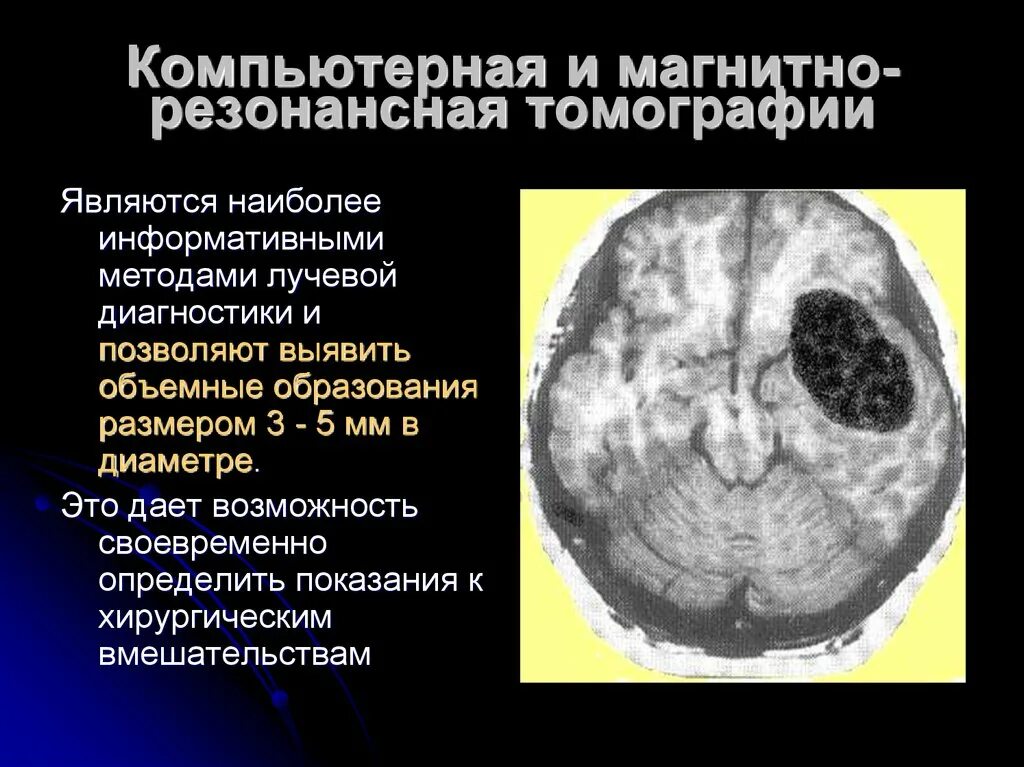 Лучевая диагностика опухолей головного мозга. Опухоли головного мозга презентация. Методы лучевой диагностики головного мозга. Диагноз опухоль головного мозга. Диагнозы опухоли мозга