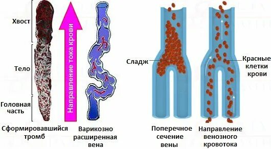 Сладж эритроцитов. Сладж феномен эритроцитов. сладж феномен.