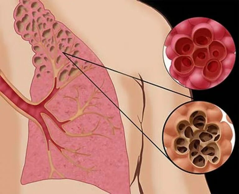 Буллезная эмфизема легкого. Народные лечение фиброза легких