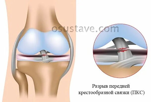 Разрыв передней крестообразной связки. Разрыв ПКС коленного сустава. Операция на крестообразной связки коленного сустава. Разрыв передней крестообразной связки коленного.