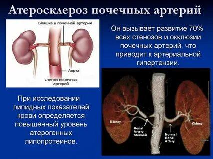 Устье почечных артерий