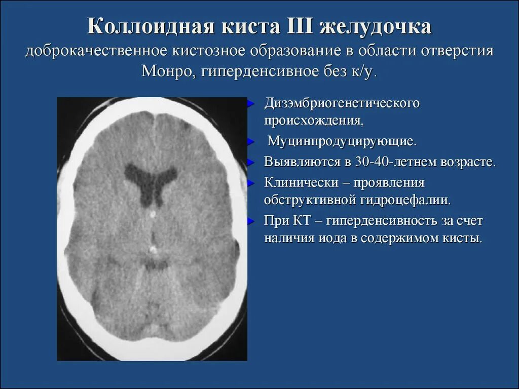 Отек мозга 3. Киста желудочка головного мозга кт. Коллоидная киста 3 желудочка головного мозга. Коллоидная киста головного мозга на кт. Коллоидная киста третьего желудочка на кт.
