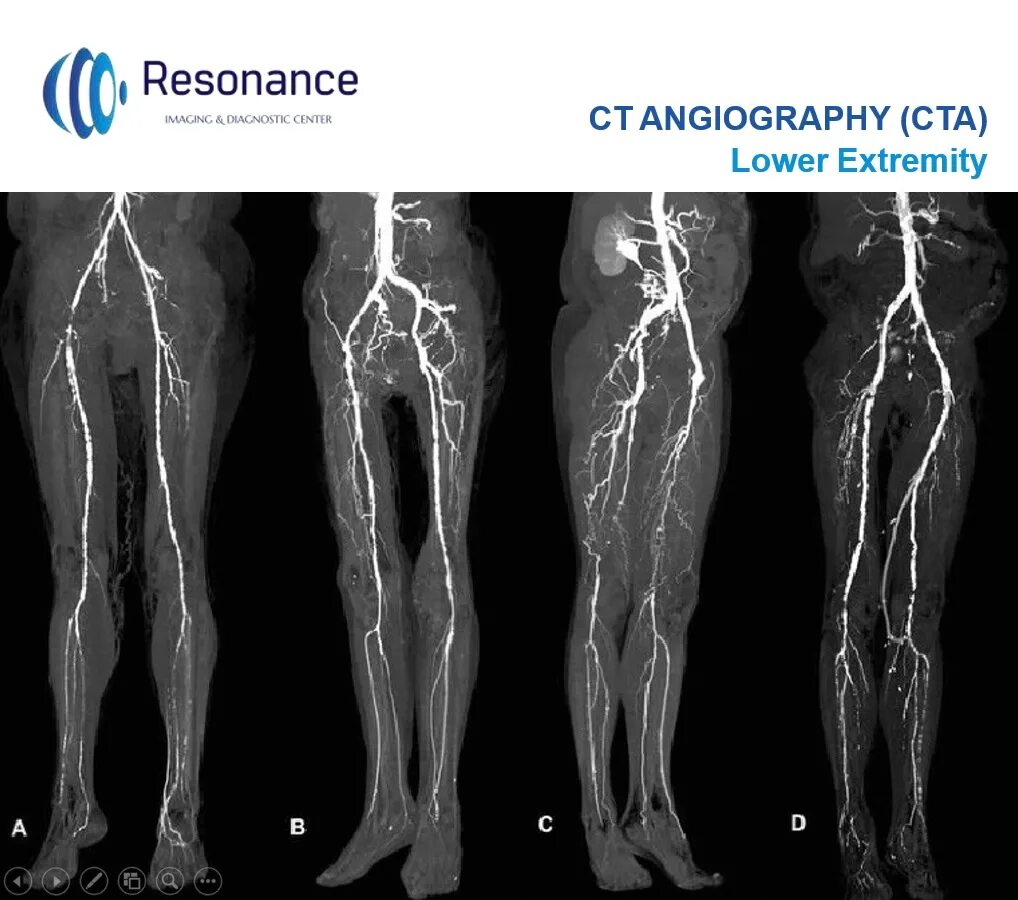 Сосуды нижних конечностей врач. Кт флебография нижних конечностей. Кт ангиография сосудов нижних конечностей с контрастированием. Ангиограмма сосудов нижних конечностей.