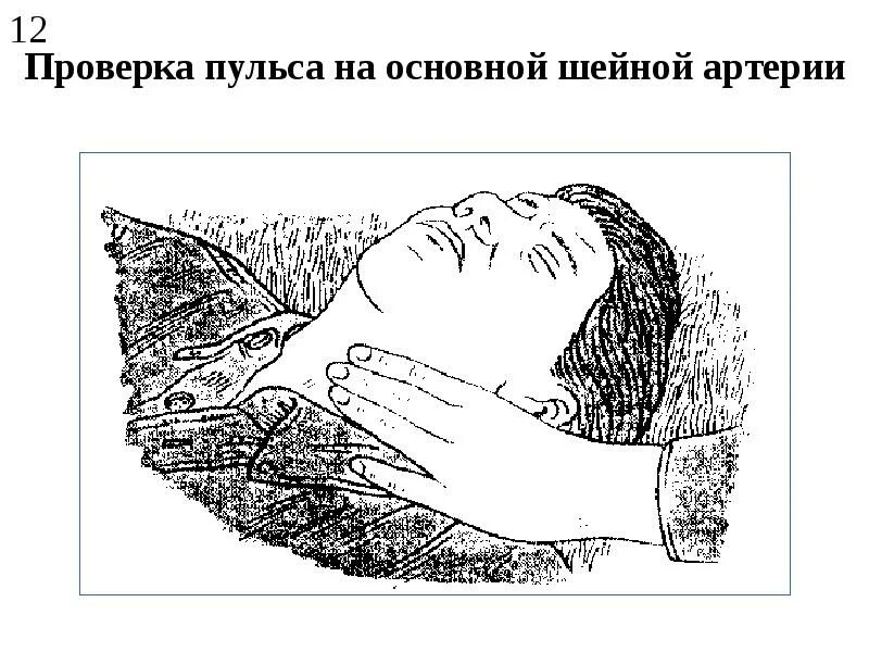 Отсутствие пульса на сонной артерии. Определение пульса первая помощь. Как определить пульс пострадавшего. Определение пульса первая помощь. Оценка состояния пульса на сонной артерии пострадавшего.