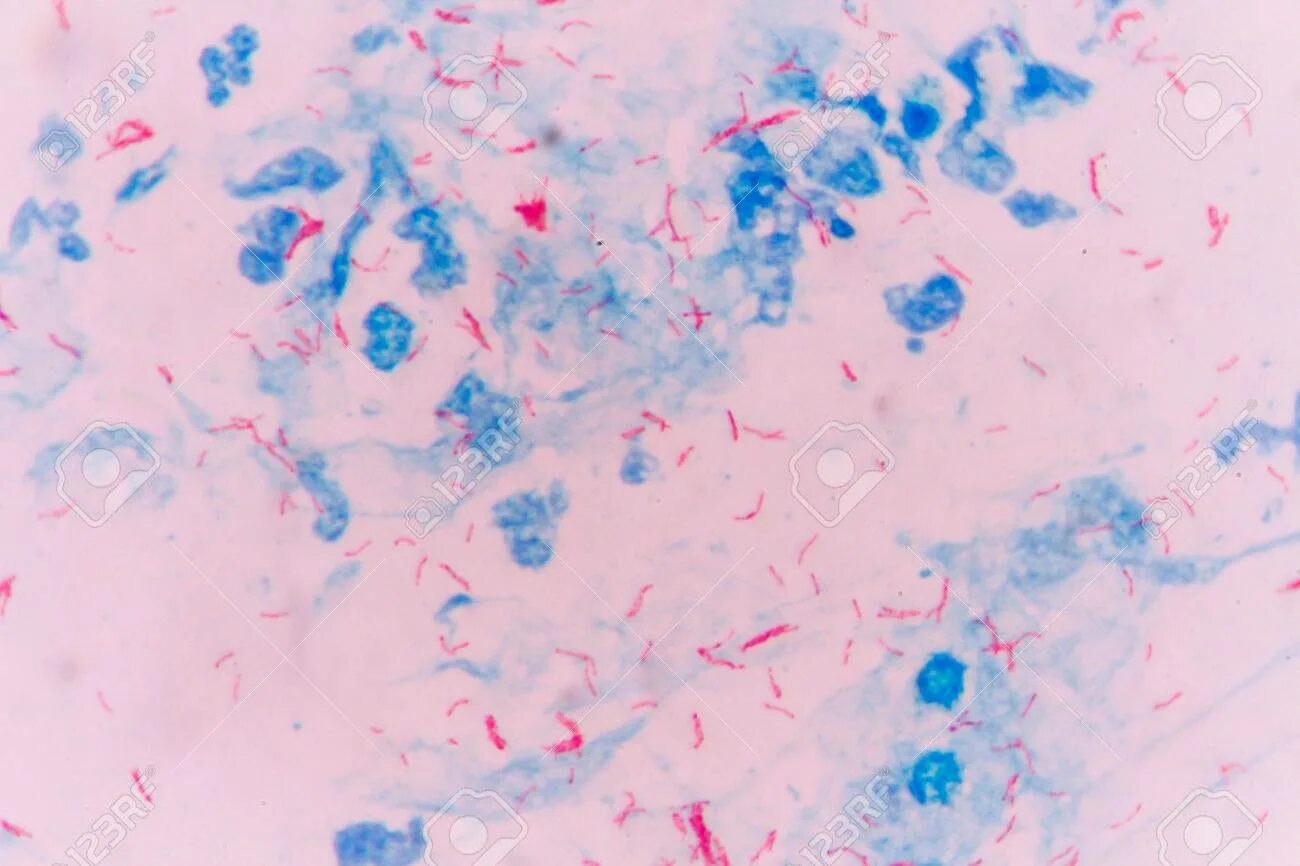 M tuberculosis по Цилю Нильсену. Бактерия туберкулеза по Цилю Нильсену. Микобактерии по Цилю Нильсену. Микроскопия по Цилю Нильсену туберкулез.