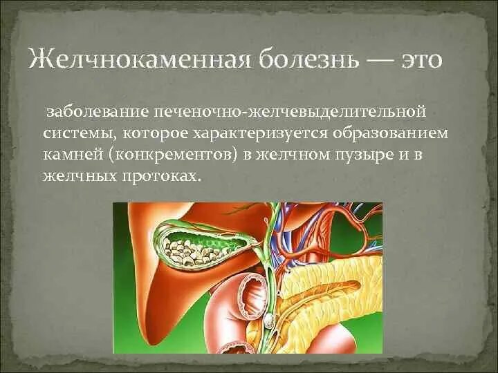 Причины жкб. Желчекаменная болезнь (ЖКБ). ЖКБ камни желчного пузыря. Желчнокаменная полезен. Желчного каменная болезнь.