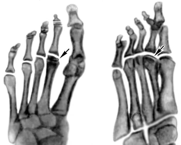 Болезнь Келлера 2 рентген. Келлера 2 болезнь 3 плюсневой кости. Келлер 1 и остеохондропатия. Остеохондропатия головки плюсневой кости рентген. Болезнь келлера что это такое