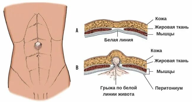 Операция на мышцы живота. Грыжа пупочная и передней брюшной стенки. Пупочная и вентральная грыжа. Грыжа белой линии живота передняя брюшная стенка. Околопупочная брюшная грыжа.