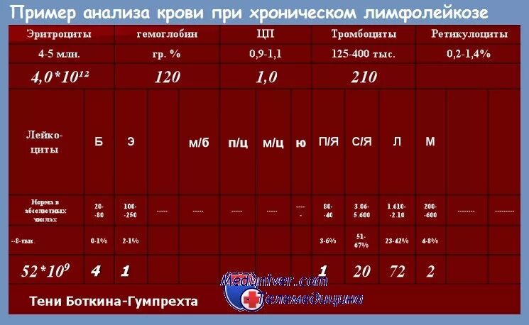 Хронический лейкоз анализ крови показатели. Хронический лимфолейкоз показатели крови. Лимфолейкоз ОАК. ОАК при хроническом лимфолейкозе. Лимфолейкоз показатели