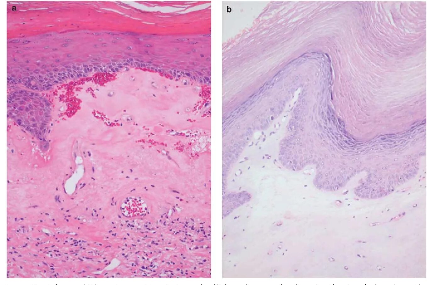 Плоскоклеточное интраэпителиальное поражение низкой. Squamous Cell carcinoma гистология. Лейкоплакия шейки матки гистология.