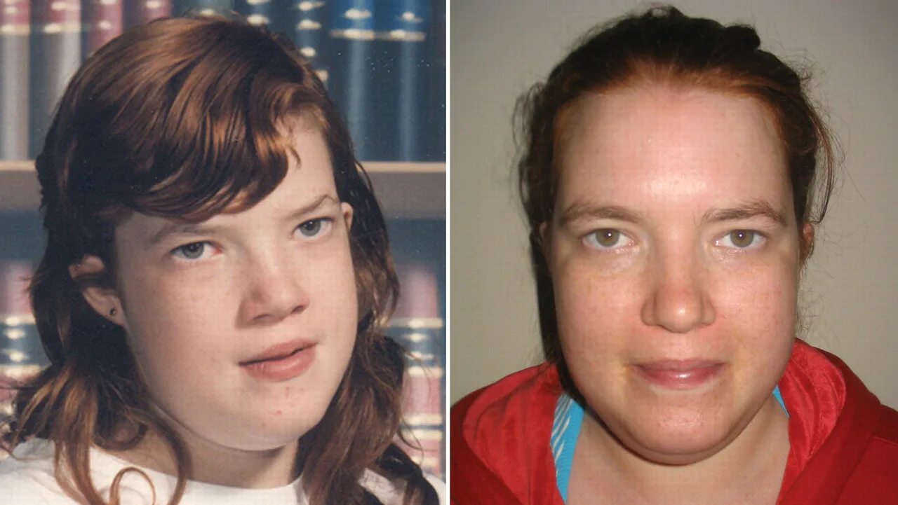 Оссифицирующая фибродисплазия. Синдром второго человека. Синдром второго человека. Фетальный алкогольный синдром плода. Синдром мартина-белла (синдром ломкой х-хромосомы).