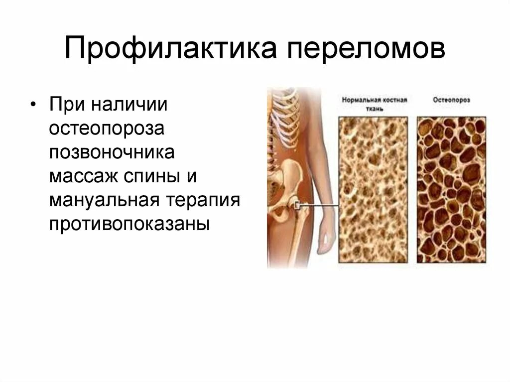 Костная ткань в норме и остеопороз. Остеопороз компрессионный перелом позвоночника. Остеопения и остеопороз. Переломы при остеопорозе. Ювенильный остеопороз.