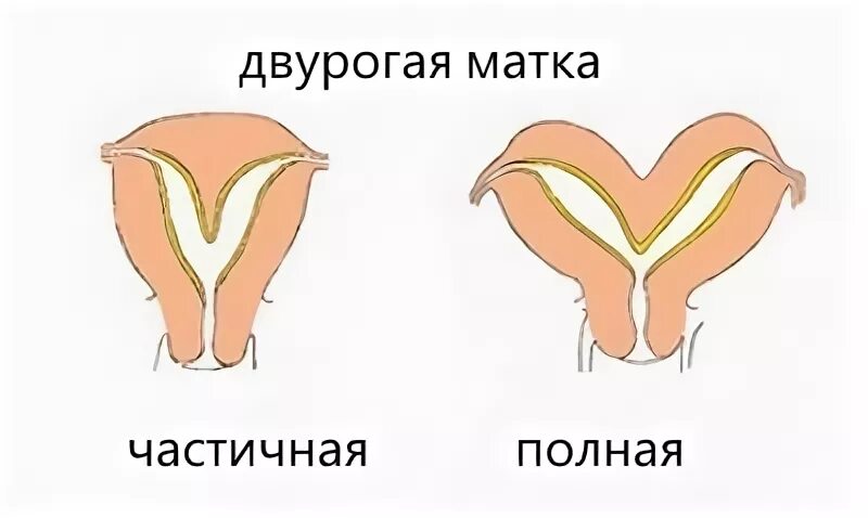 Что такое две матки у женщины. Неполная форма двурогой матки. двурогая матка и обычная. неполная двурогая матка.