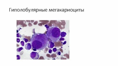 Миелодиспластический синдром клинические рекомендации