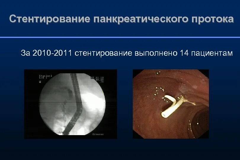 Эндоскопическое стентирование панкреатического протока. Стентирование вирсунгова протока. Стентирование вирсунгова протока поджелудочной железы. Стент желчного протока ЭРХПГ. Стент желчного протока