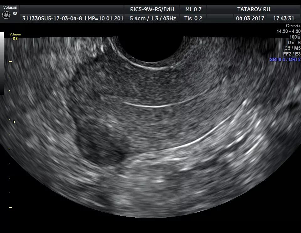 Миома матки малых размеров на УЗИ. Субмукозная миома матки УЗИ. Ультразвуковая анатомия матки. Ультразвуковое исследование матки и придатков трансректальное.