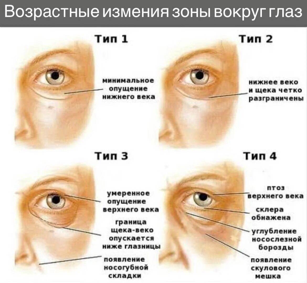 Веко верхнее птоз 1 степени. Птоз ( опущение верхнего века. Степени птоза Нижнего века. Птоз глаз Нижнего века.