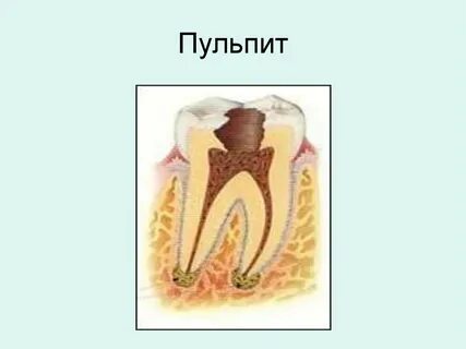 Повреждение пульпы