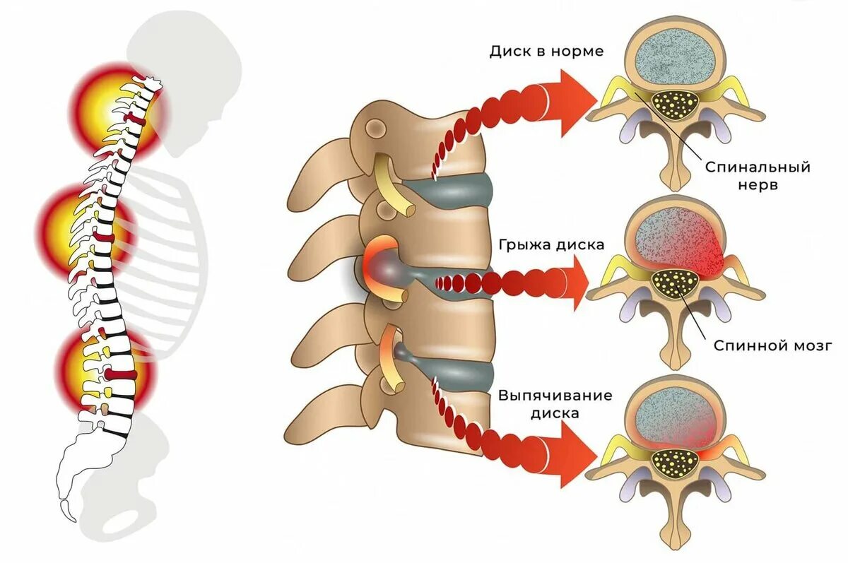 Грыжи дисков поясничного отдела позвоночника. Межпозвоночная грыжа поясничного отдела симптомы. Межпозвонковая грыжа грудного отдела симптомы. Грыжи дисков позвонков. Грыжа диска позвоночника поясничного отдела.