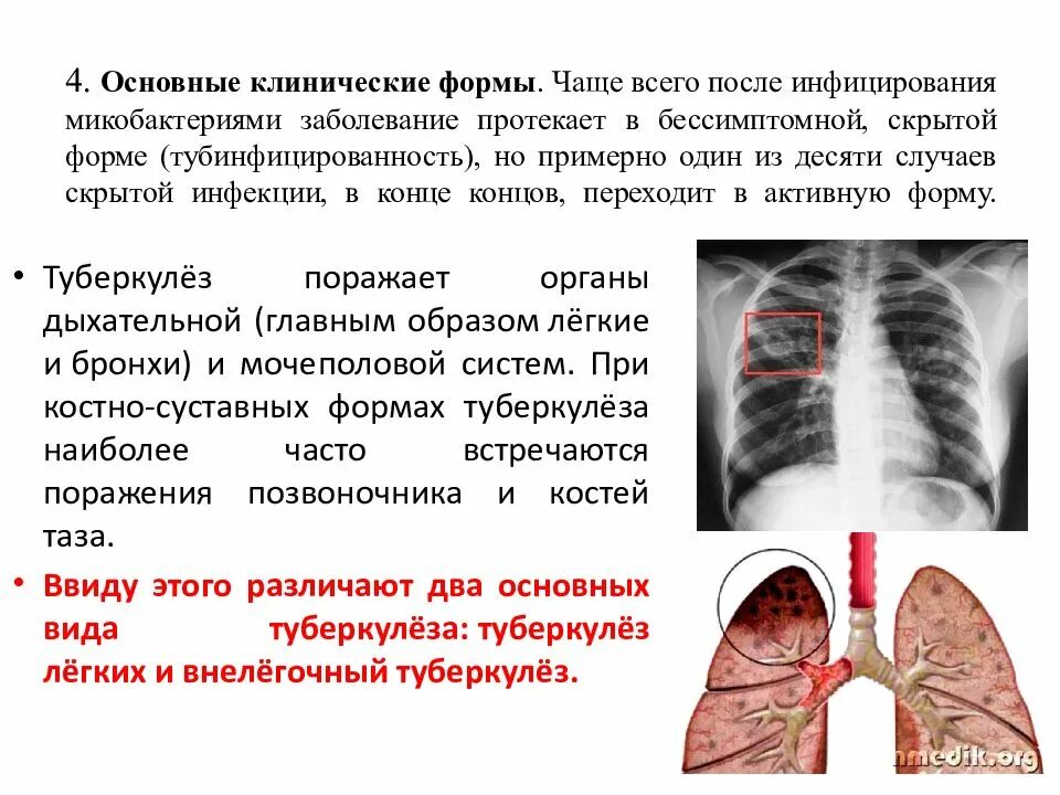 Закрытая форма туберкулеза можно ли заразиться