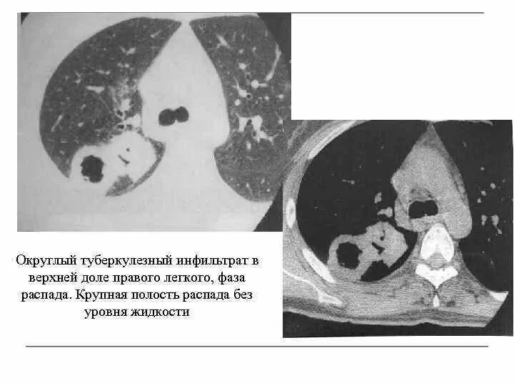 Округлый инфильтрат. Инфильтративный туберкулез в фазе распада кт. Туберкулез верхней доли правого легкого на кт. Инфильтративный туберкулез на кт. Инфильтративный туберкулез легких кт.