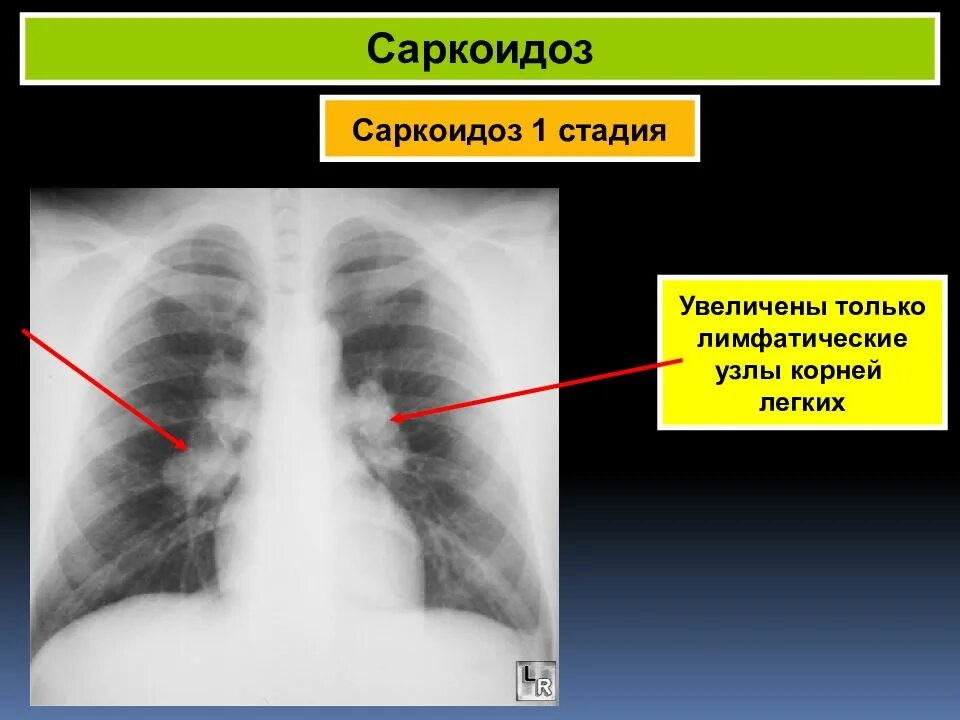 Легкие увеличен узел. Саркоидоз рентген 4 стадия. Саркоидоз 2 стадии рентген. Саркоидоз внутригрудных лимфатических узлов рентген.