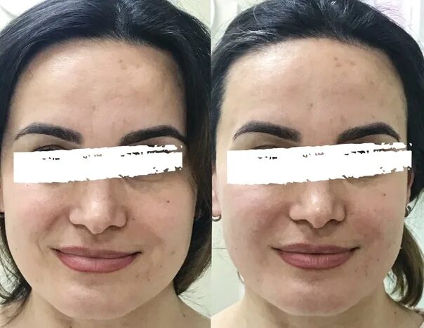 Beauty Insider: Удаление устойчивых пигментных пятен: личный опыт СМИ о клинике 